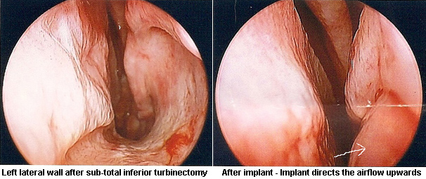 File:Before and after Alloderm implant to the lateral wall.jpg