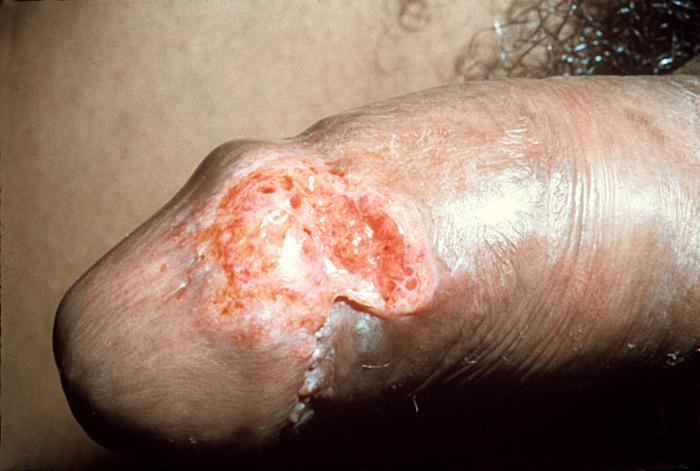 Penile lesion of roughly determined to be granuloma inguinale. Adapted from Dermatology Atlas.[1]