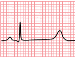 File:Long QT Syndrome.PNG