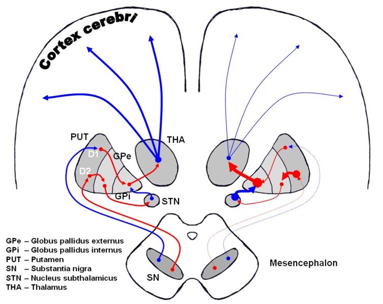 Dopaminergic pathways of the human brain in normal condition (left) and Parkinson's disease (right). Red Arrows indicate suppression of the target, blue arrows indicate stimulation of target structure.