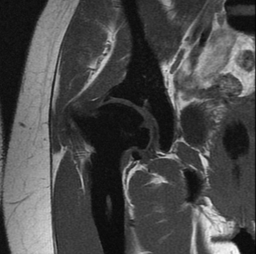 Osteopetrosis MRI 206.jpg