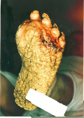 Plantar keratosis in Cowden syndrome