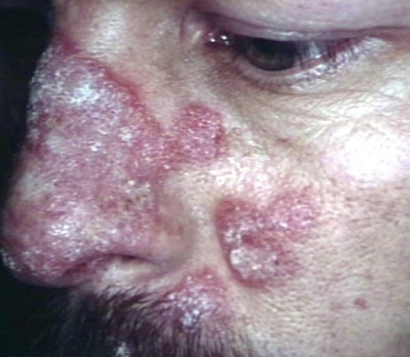 Skin: discoid lupus, face. Image courtesy of Professor Peter Anderson DVM PhD and published with permission © PEIR, University of Alabama at Birmingham, Department of Pathology.[1]