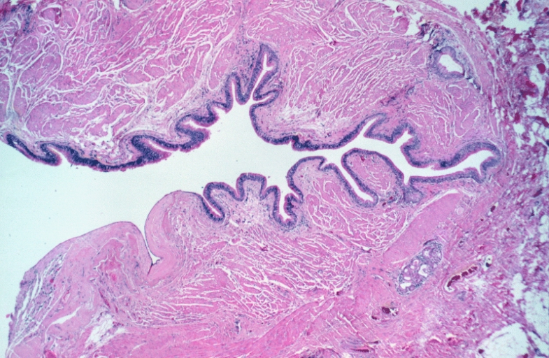 Lower Respiratory Tract: Bronchogenic cyst; There is a cyst lined by bronchiolar epithelium and thick fascicles of smooth muscle in the wall. Islands of cartilage and submucosal salivary glands are lacking and the designation "foregut cyst consistent with bronchogenic cyst" might be more appropriate.