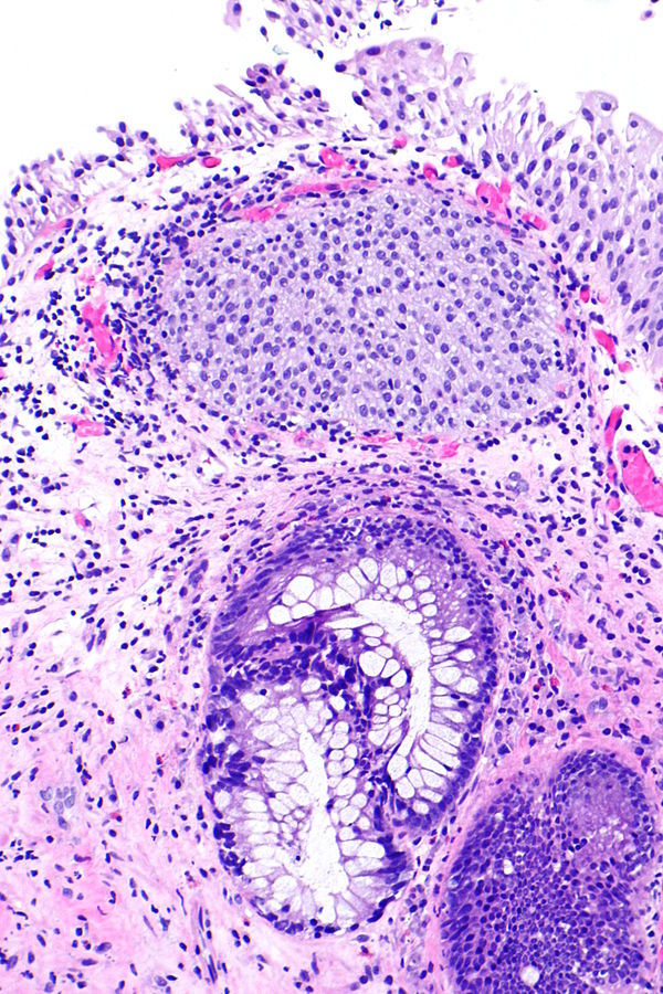 Cystitis Glandularis. Source: Libre Pathology[52]