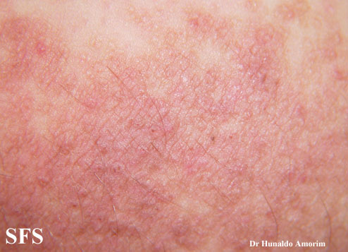 Darier-like epidermal naevus. Adapted from Dermatology Atlas.[3]