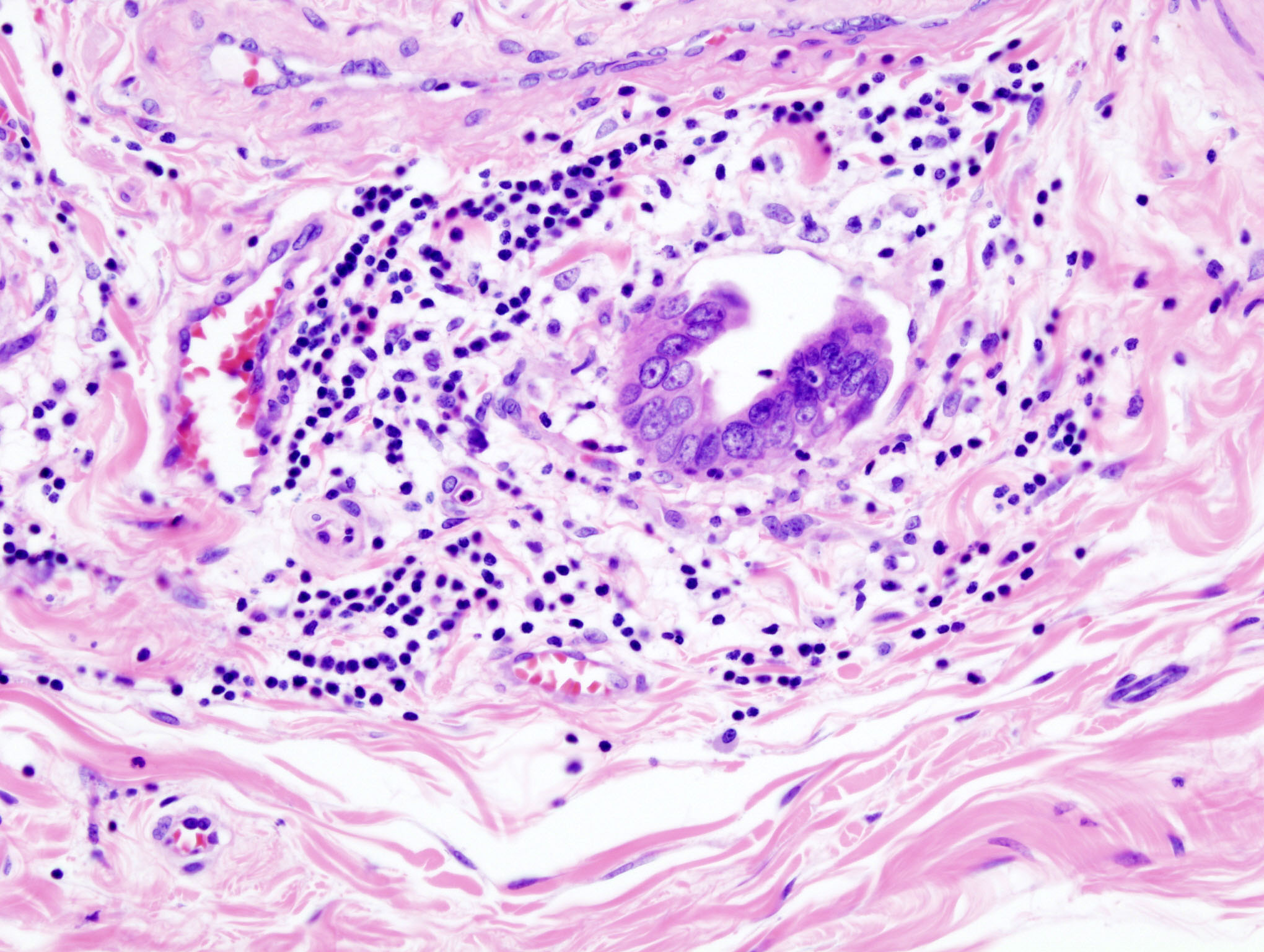 Gallbladder adenocarcinoma: Lymphatic invasion histopathology