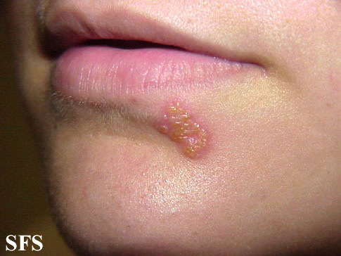 File:Herpes simplex 18.jpeg