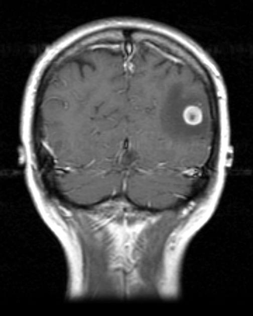Coronal T1 C+ head within the parieto-occipital region on the left demonstrates a very rounded brightly peripherally enhancing mass located near the grey-white junction, surrounded by a moderate amount of vasogenic edema. The central region of lower signal intensity does not enhance nor does it restrict. Features are consistent with the patient's known metastatic disease with bull's eye sign.[4]