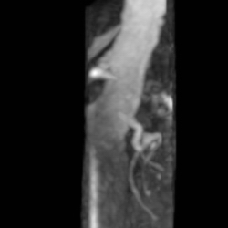 File:Renal artery stenosis 027.jpg