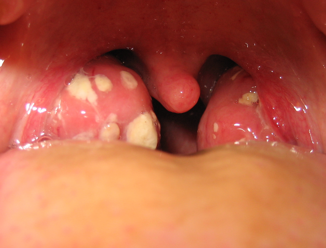 Acute tonsillitis