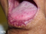 Osler weber rendu disease. With permission from Dermatology Atlas.[3]