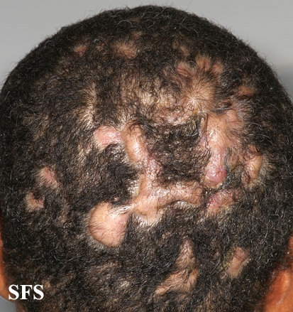 Perifolliculitis capitis. Adapted from Dermatology Atlas.[4]
