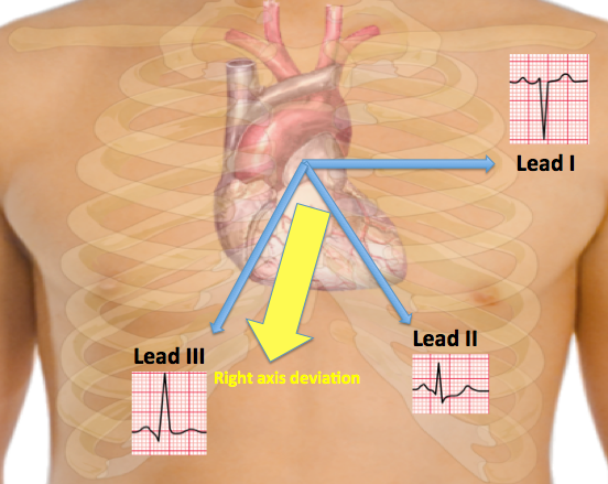In right axis deviation, lead I shows negative deflection whereas lead II and III show positive deflection waves