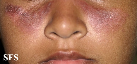 Systemic lupus erythematosus. Adapted from Dermatology Atlas.[9]
