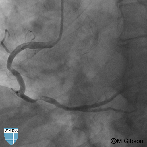 TIMI grade 4 thrombus in the RCA: Note that the linear dimension of the outlined lesion is two times larger than the diameter of the adjacent artery.