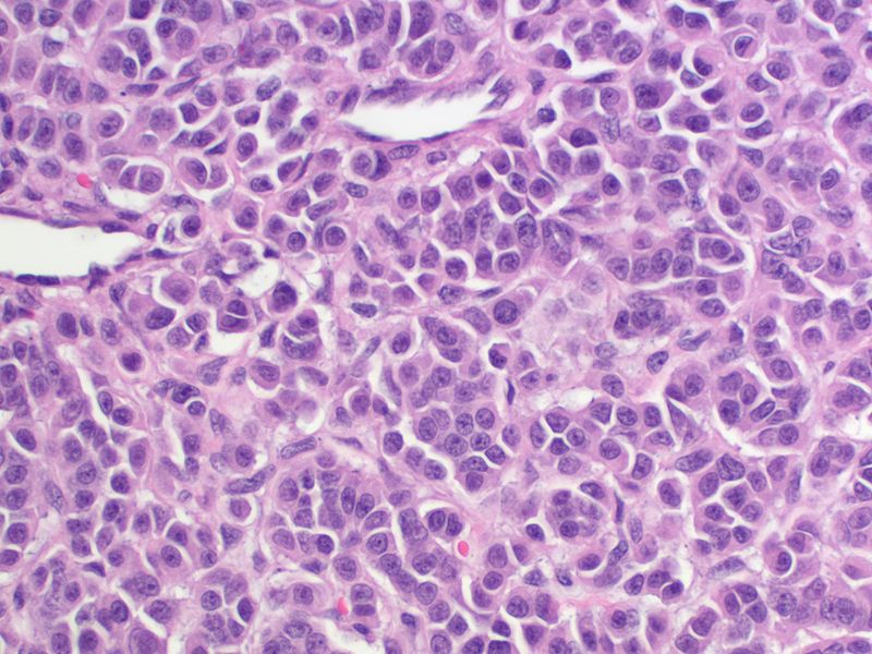 File:Thyroid MedullaryCarcinoma SmallCellVariant HP CTR (3).jpg