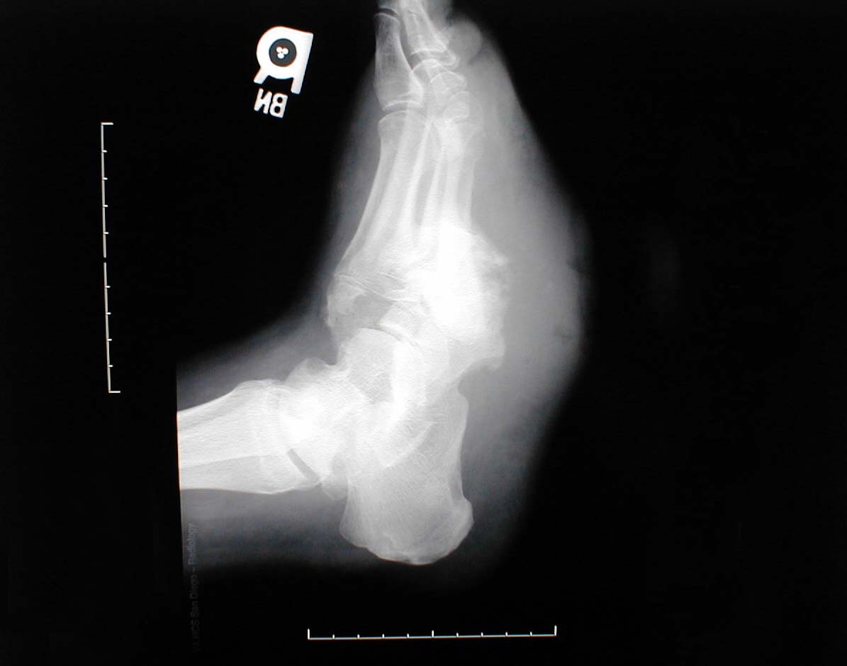 Lateral x-ray demonstrates marked soft tissue swelling as well as bony destruction caused by underlying osteomyelitis.