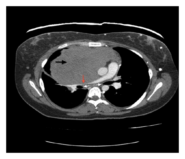 CT scan of the chest with contrast reveals a large lobulated anterior mediastinal solid mass (black arrow) with extension into the right hemithorax and the right atrium. There is displacement of the great vessels into the left hemithorax with significant mass effect on the right upper lobe. The tumor causes compression of the right pulmonary artery (red arrow) and right and left mainstem bronchi (white arrows).[5]