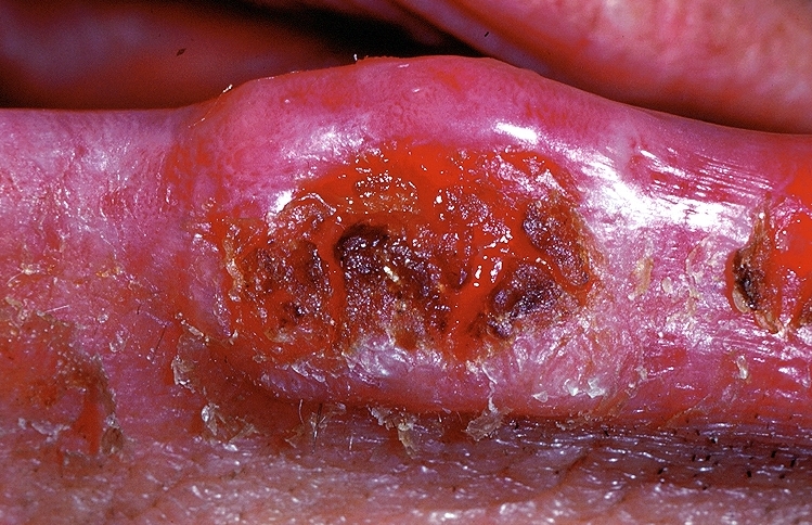 Squamous cell carcinoma in the oral cavity. Image courtesy of Professor Peter Anderson DVM PhD and published with permission © PEIR, University of Alabama at Birmingham, Department of Pathology