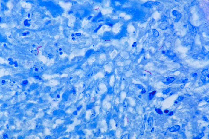 Histopathology of tuberculosis, placenta.Adapted from Public Health Image Library (PHIL), Centers for Disease Control and Prevention.[26]