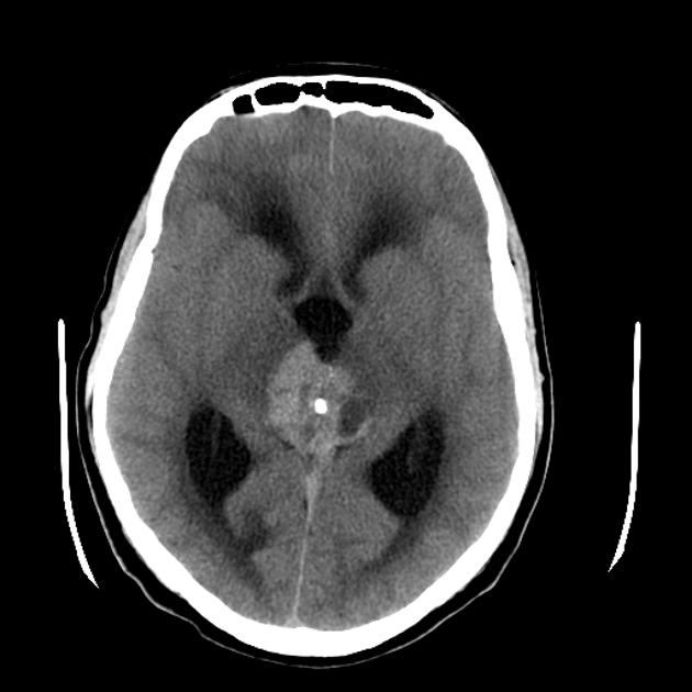Axial noncontrast CT image demonstrating a large lobulated mass centered on the pineal gland, engulfing the pineal calcifiation. It is somewhat hyperdense compared to adjacent brain. A further smaller mass is seen in the floor of the third ventricle. The midbrain is distorted and compressed, demonstrating low density suggestive of edema. Obstructive hydrocephalus is present.[18]