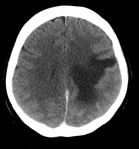 File:CT scan of brain metastasis 9.jpg