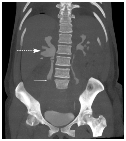 Obstruction of the right ureter (thin arrow) by the enlarged right ovarian vein (thick dashed arrow)[2]
