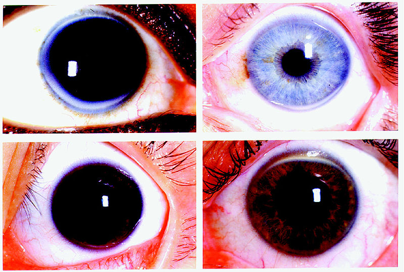 File:Four representative slides of corneal arcus.jpg