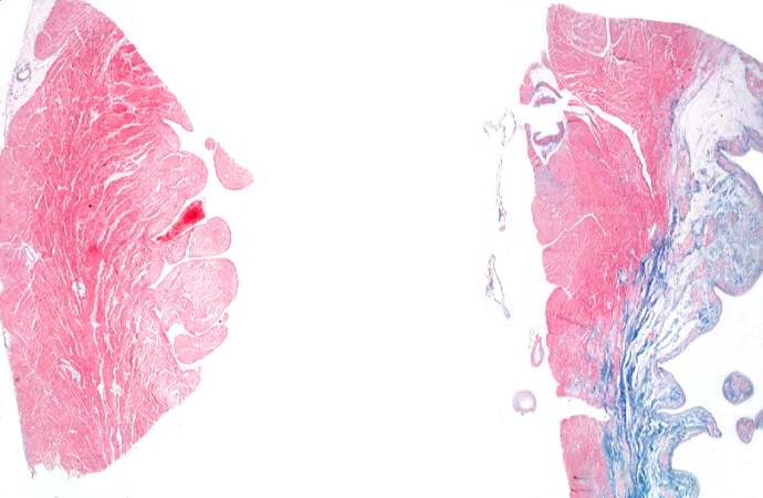 This is a low-power photomicrograph of two sections of myocardial tissue stained with a trichrome stain to demonstrate fibrous connective tissue (blue). The section on the left is from a heart with a recent myocardial infarction. Notice the absence of fibrous connective tissue. The section on the right is from a heart with an old healed infarct and it contains extensive fibrous connective tissue scars.