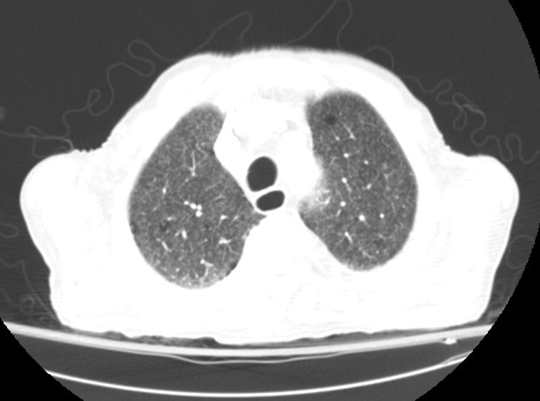 File:Miliary tuberculosis CT 101.jpg