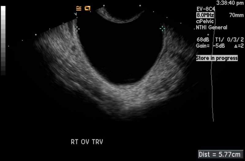 Ovarian cyst 104.jpg