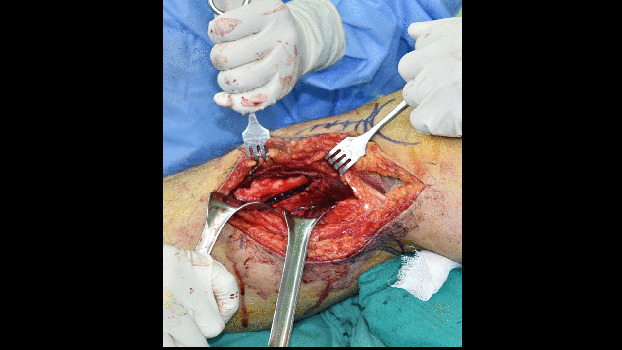 File:Surgery 6 intraop.gif