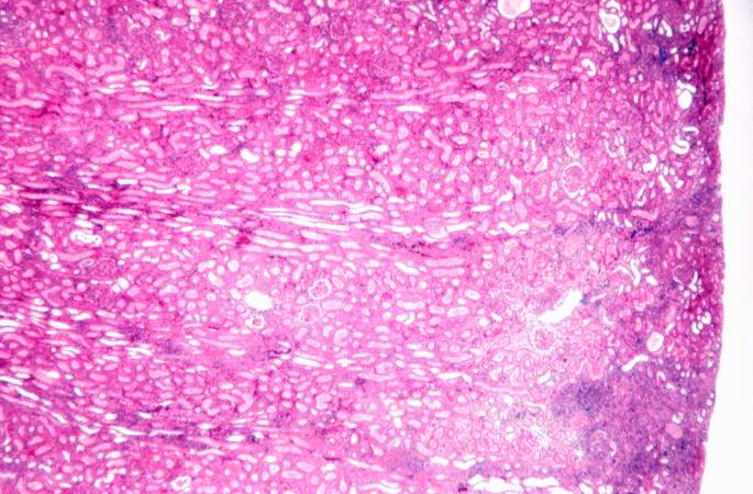 This is a higher-power photomicrograph demonstrating the cellular infiltrates within this kidney section.