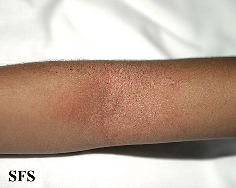 Atopic Dermatitis. Adapted from Dermatology Atlas.