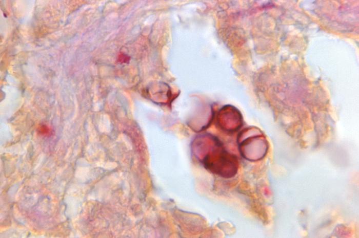 Gridley-stained photomicrograph reveals histopathologic changes, indicative of the chronic fungal disease process known as chromoblastomycosis, or chromomycosis. From Public Health Image Library (PHIL). [2]