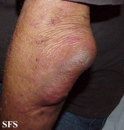Ganglion cyst. Adapted from Dermatology Atlas.[2]