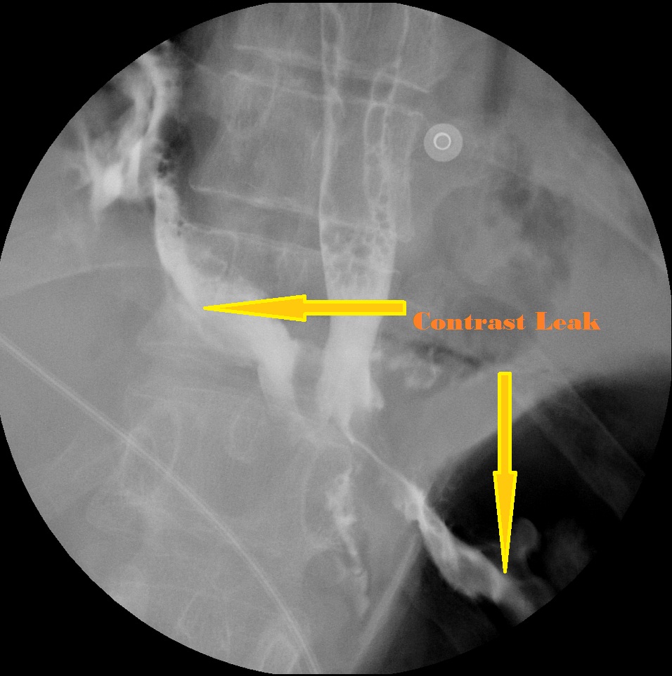 Gastrografin Esophagram: With the ingestion of Gastrografin, a right-sided oesophageal leak into the pleural space quickly occurs. The leak crosses over slightly into the left pleural space and extends a little into the retrocrural/retroperitoneal space as well.; Source- Radiopaedia
