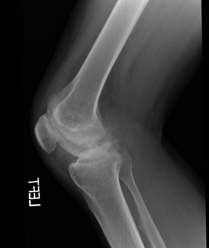 X-ray of the ankle in a patient with Hemophilia