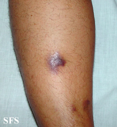 Kaposi's sarcoma. Adapted from Dermatology Atlas.[2]