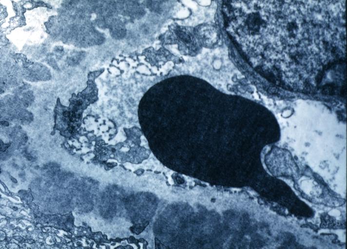 Membranous Glomerulonephritis: Electron micrography. An excellent example to show thickened basement membrane and immune complexes.