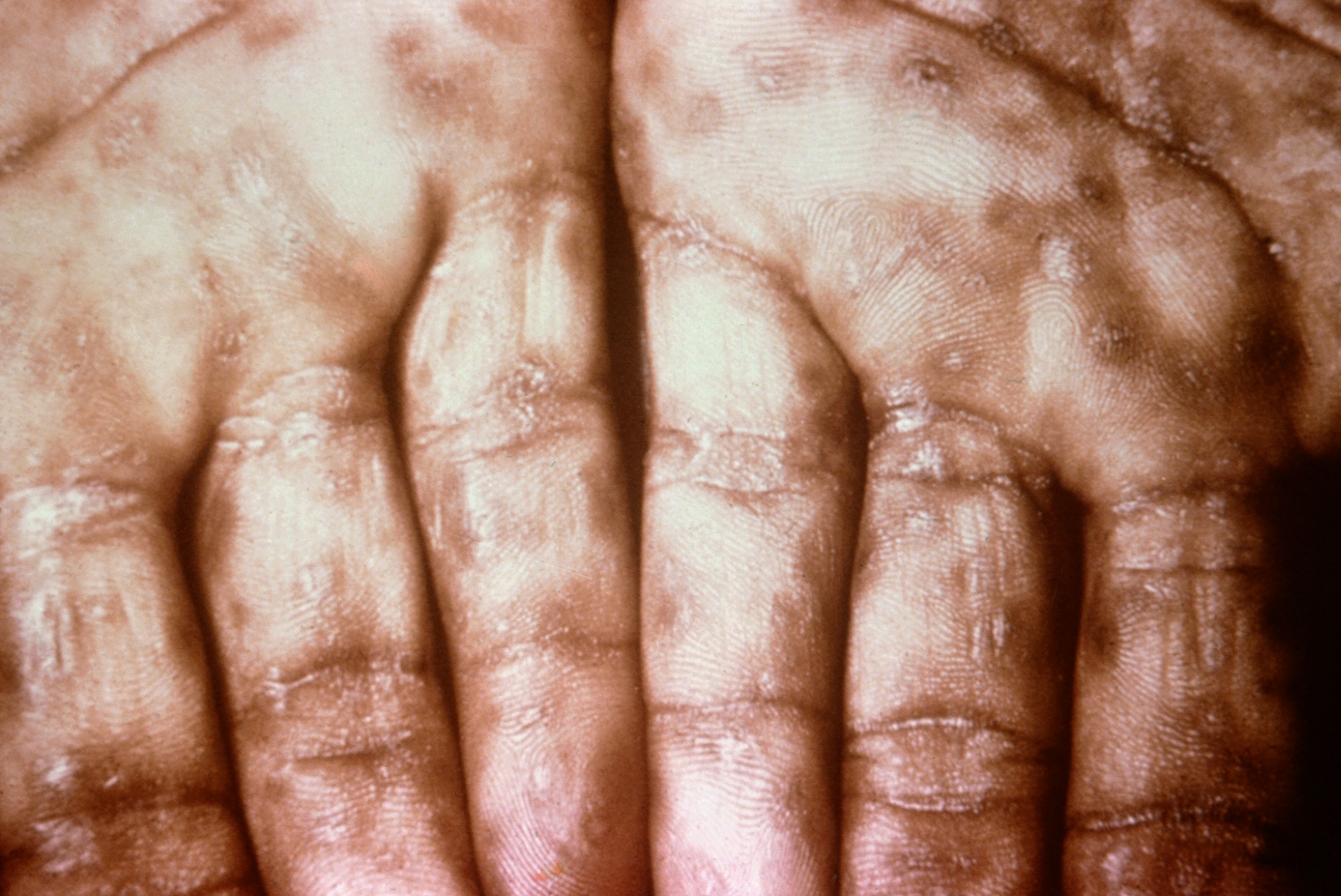 Typical presentation of secondary syphilis rash on the palms of the hands and usually also seen on soles of feet