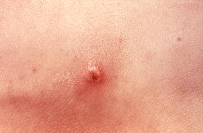 This patient presented with a cutaneous lesion that was traced to a systemically disseminated gonoccal infection. Though a sexually transmitted disease, if a Gonorrhea infection is allowed to go untreated, the Neisseria gonorrhea bacteria responsible for the infection can become disseminated throughout the body, forming lesions in extra-genital locations.Adapted from CDC
