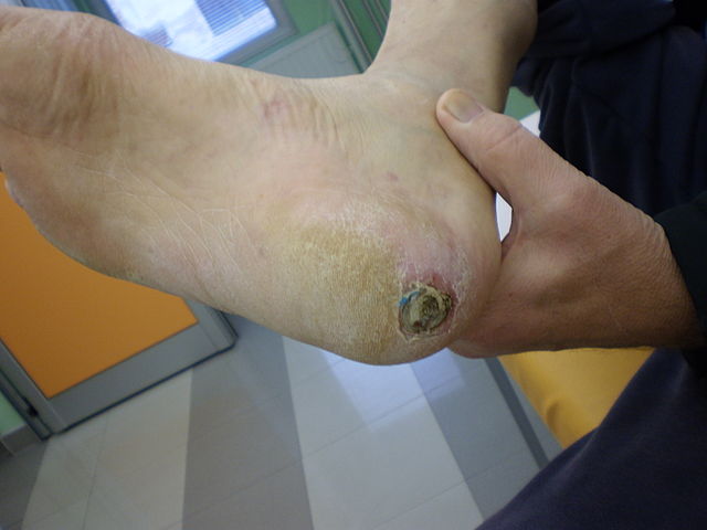 File:Dijabetesno stopalo 2011 1.jpg