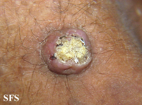 Keratoacanthoma. Adapted from Dermatology Atlas.[1]