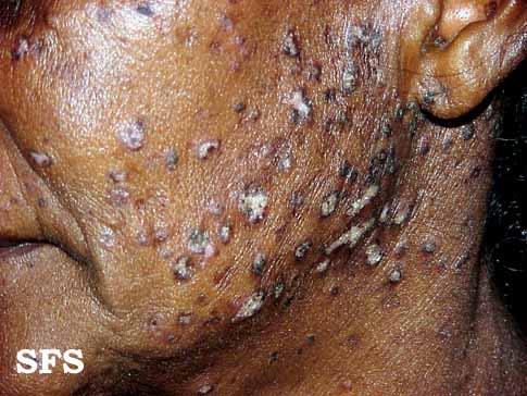 File:Lupus erythematosus chronicus disseminatus superficialis07.jpg