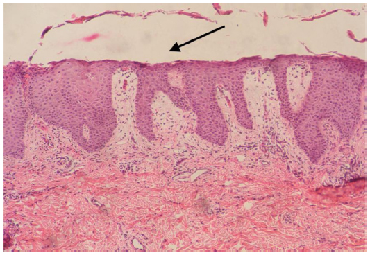 Skin biopsy in necrolytic migratory erythema showing a large zone of necrolysis in the upper epidermis (arrow)[12]