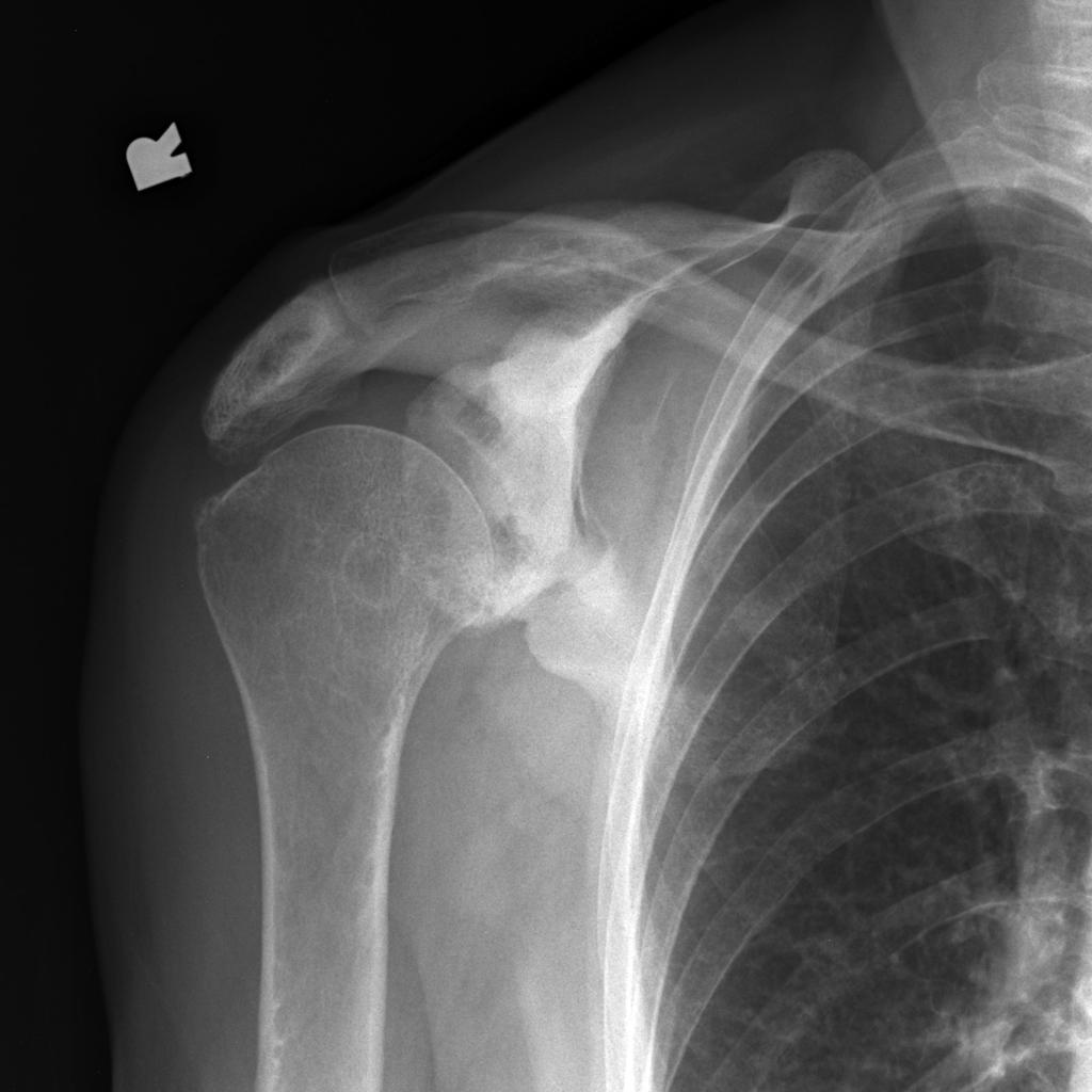 File:Paget-disease-of-the-scapula.jpg
