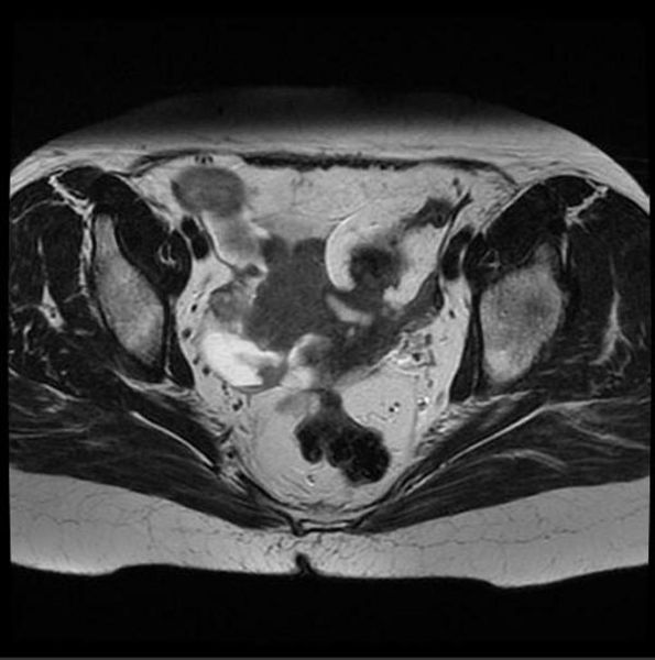 File:Primary-fallopian-tube-carcinoma-002.jpg