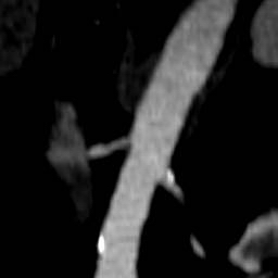 Atherosclerotic plaques seen in the distal aortic arch, aortic bifurcation, and in the external iliac arteries. right renal artery stenosis. A 74 year-old male who is status post thromboembolic event of his RLE.